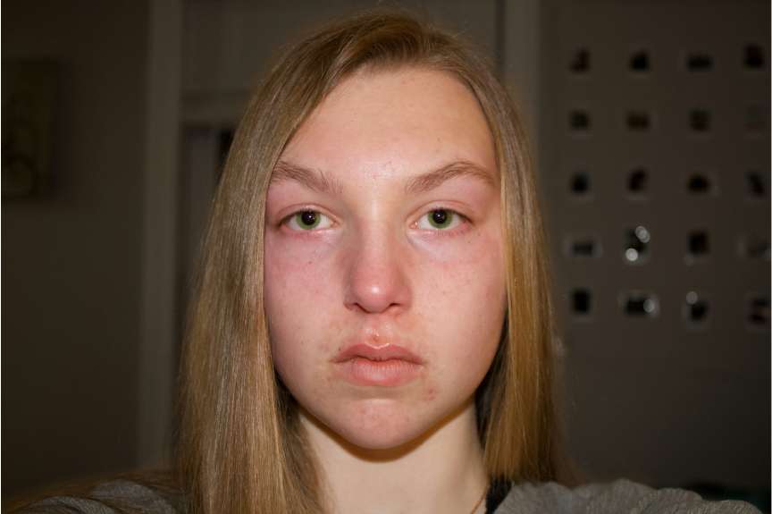 Eine junge Frau mit sichtbaren Hautirritationen aufgrund zu vieler Pflege