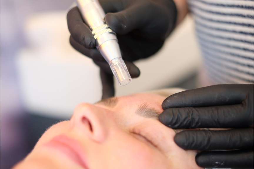 Eine Frau während der Microneedling Behandlung. Die Stirn wird mit dem Nadelgerät behandelt.
